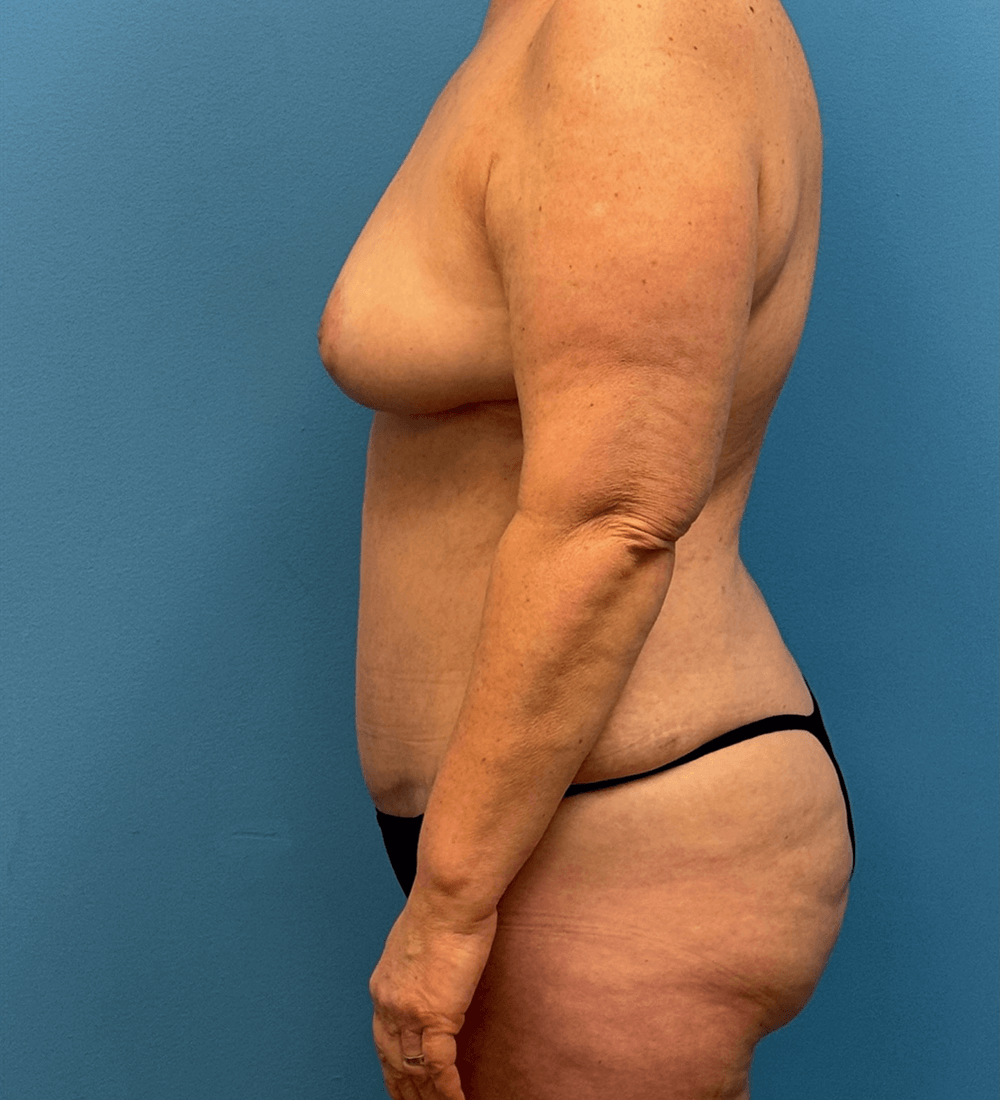 Case--27387 | After Mommy Makeover 2