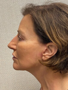 Case--9966 | After Facelift 2