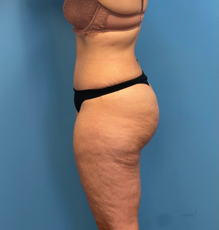 Tummy-Tuck-Case--25555 | After Tummy Tuck 2