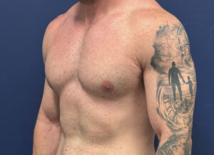 Gynecomastia-Case--28230 | After Gynecomastia / Male Breast Reduction 2