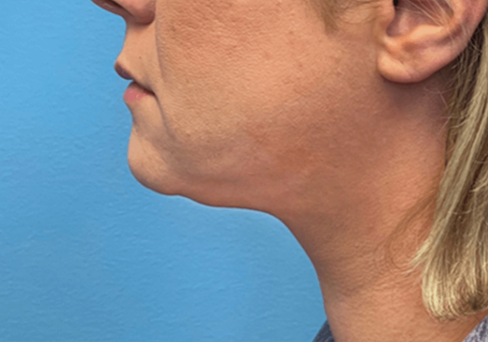 Case--20811 | After Liposuction 1