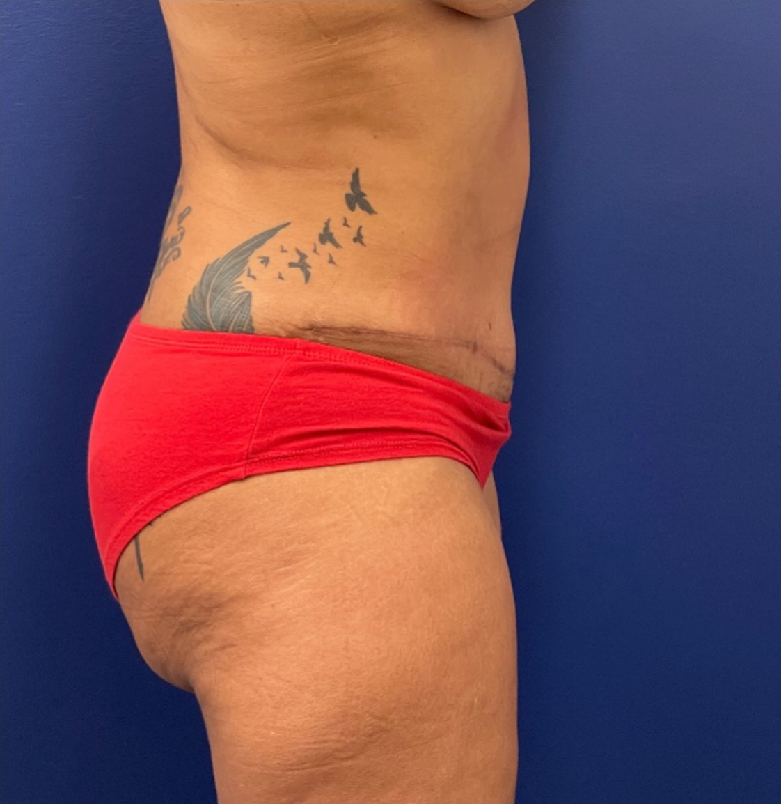 Liposuction-Case--254 | After Liposuction 2