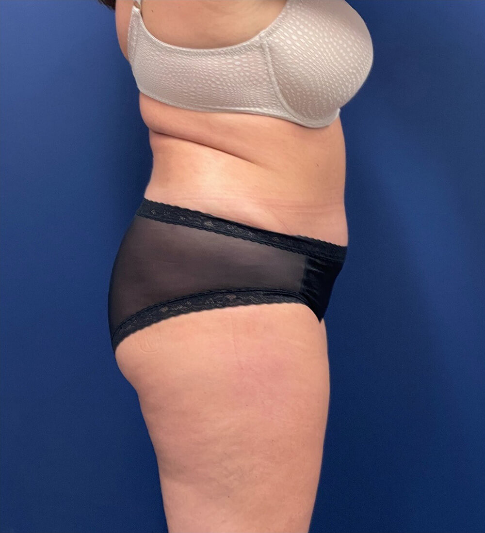 Case--24903 | After Tummy Tuck 2