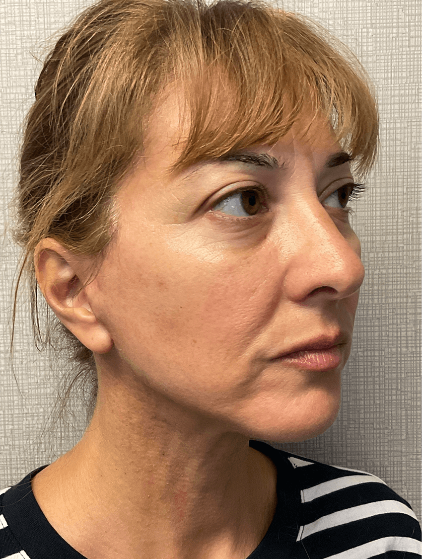 Case--20575 | After Facelift 2