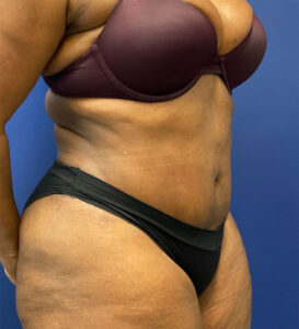 Lipoabdominoplasty-Case--24124 | After Tummy Tuck 2