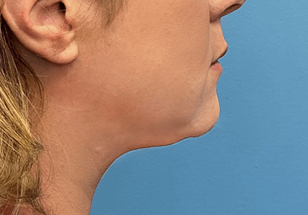 Case--20811 | After Liposuction 2