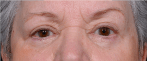 Blepharoplasty-Case--6005 | After Eyelid Surgery 1