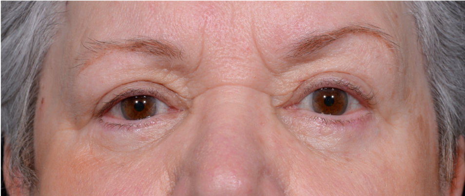 Blepharoplasty-Case--6005 | After Eyelid Surgery 1