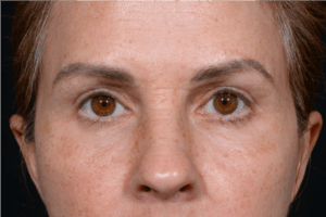 Quad-Blepheroplasty-Case--5361 | After Dr. Arjun Kanuri 1
