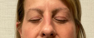 Upper-Blepharoplasty-Case--7202 | Before Dr. Arjun Kanuri 2