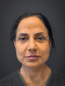 Facial-Fat-Grafting-Case--8416 | After Facial Fat Grafting 1