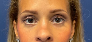 Quad-Blepharoplasty-Case--1261 | After Dr. Arjun Kanuri 1