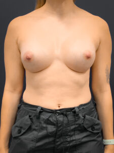Breast-Augmentation-Case--2225 | After Dr. Arjun Kanuri 1