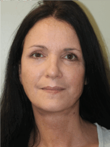 Facelift-Case--9078 | After Facelift 1