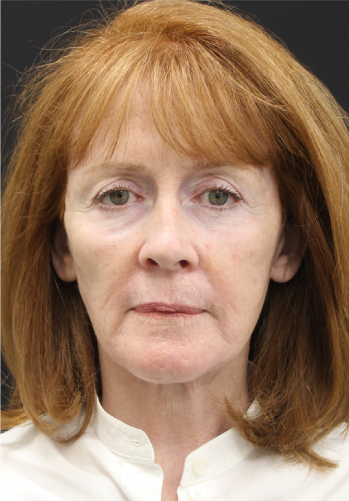 Face-and-Neck-Lift-Case--9302 | After Facelift 1