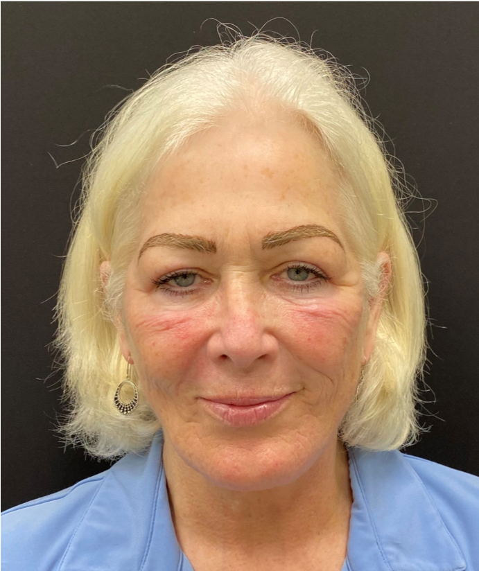 Face-and-Neck-Case--1975 | After Facelift 1