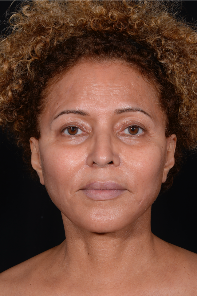 Face-and-Neck-Lift-Case--3772 | After Facelift 1