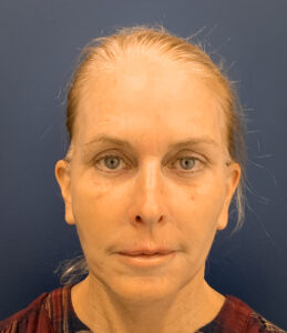 Facelift-Case--2253 | After Facelift 1