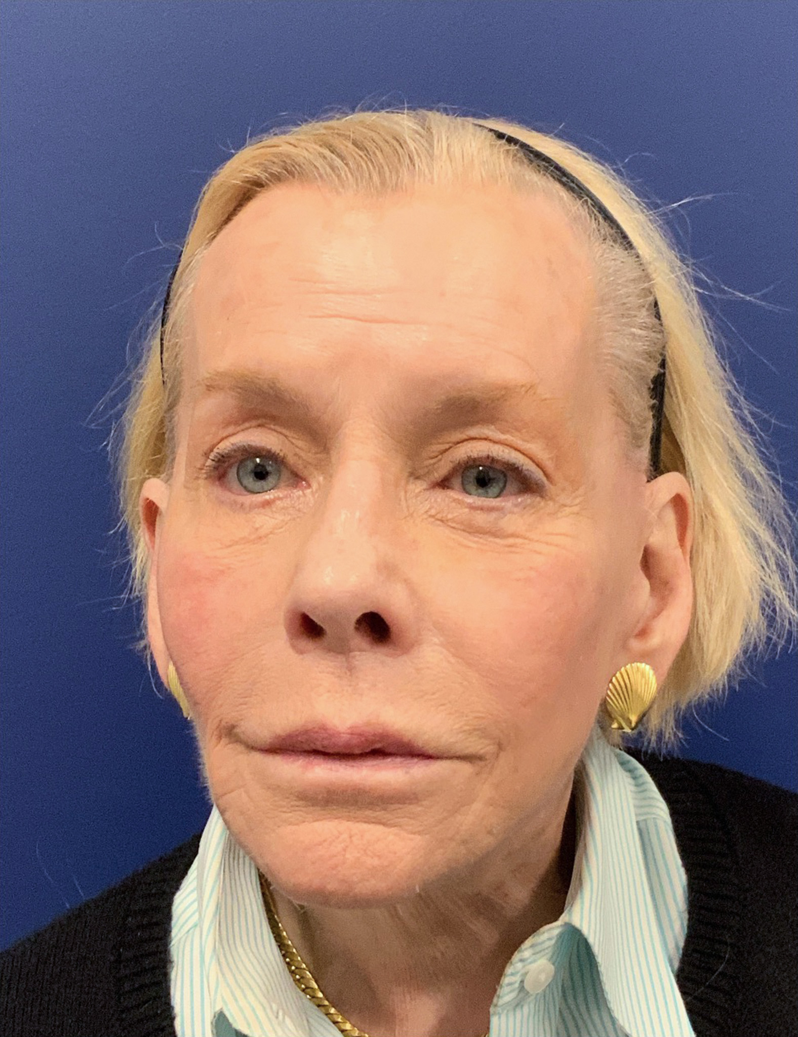 Facelift-Case--9999 | After Facelift 1