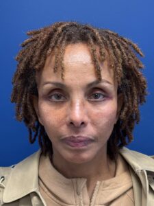 Facelift-Case--1863 | After Facelift 1