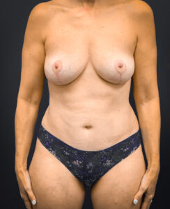 Breast-Augmentation-Case--1469 | After Dr. Arjun Kanuri 1