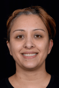 Otoplasty-Case--4655 | After Otoplasty 1