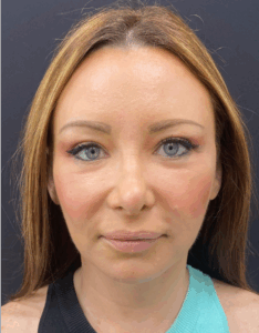 Facial-Fat-Grafting-Case--1679 | After Facial Fat Grafting 1