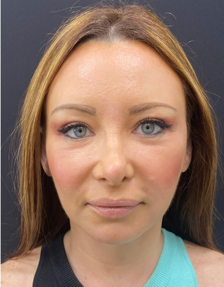 Revision-Facelift-Case--5350 | After Facelift 1