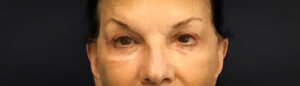 Upper-Blepharoplasty-Case--2075 | After Dr. Arjun Kanuri 1