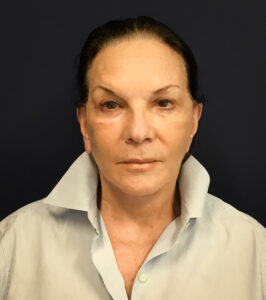 Revision-Facelift-Case--3082 | After Facelift 1