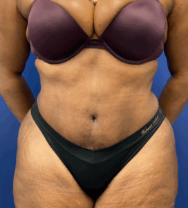 Abdominoplasty-Case--4427 | After Tummy Tuck 1