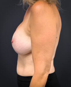Breast-Augmentation-Case--3336 | After Dr. Arjun Kanuri 2