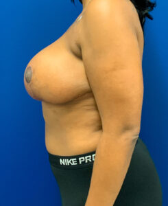 Breast-Reduction-Case--9235 | After Breast Reduction 2