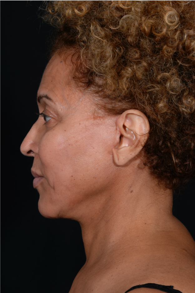 Face-and-Neck-Lift-Case--3772 | After Facelift 2