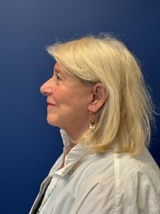 Facelift-Case--6034 | After Facelift 2