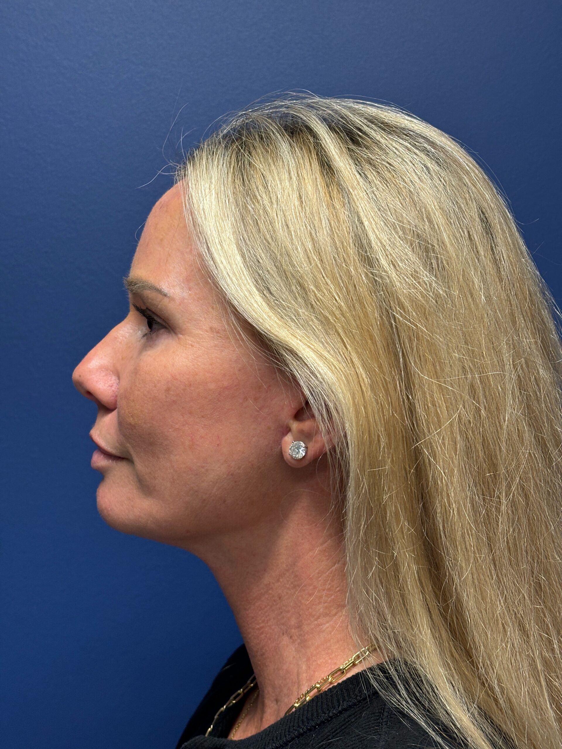 Facelift-Case--9781 | After Facelift 2