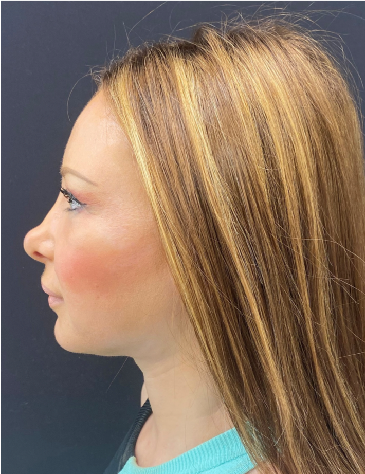 Revision-Facelift-Case--5350 | After Facelift 2