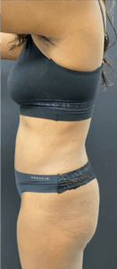 Abdominoplasty-Case--6650 | After Liposuction 2