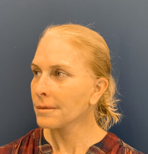 Facelift-Case--2253 | After Facelift 2