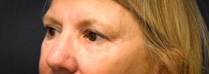 Blepharoplasty-Case--2653 | After Eyelid Surgery 2