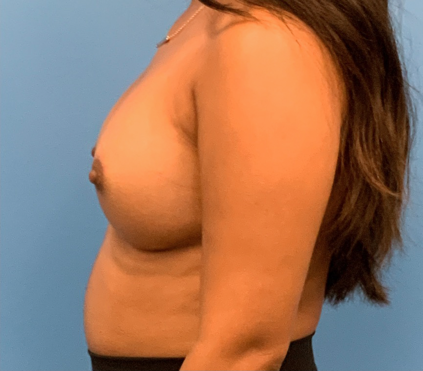 Breast-Augmentation-Case--1115 | After Breast Augmentation 2