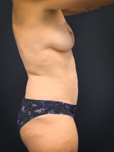 Breast-Augmentation-Case--1469 | After Dr. Arjun Kanuri 2