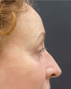 Blepharoplasty-Case--9685 | After Eyelid Surgery 2