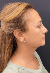 Rhinoplasty-Case--8713 | After Rhinoplasty 2