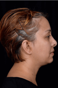 Otoplasty-Case--4655 | After Otoplasty 2