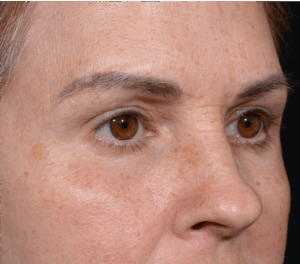 Quad-Blepheroplasty-Case--5361 | After Dr. Arjun Kanuri 2
