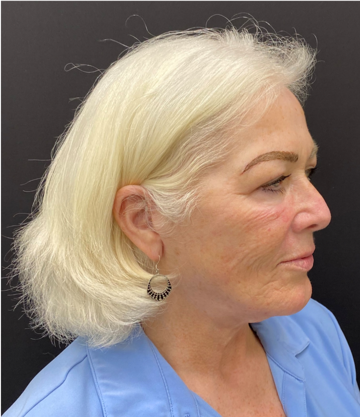 Face-and-Neck-Case--1975 | After Facelift 2