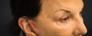 Upper-Blepharoplasty-Case--2075 | After Dr. Arjun Kanuri 2