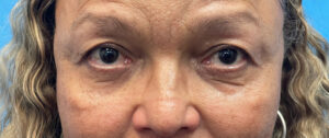 Upper-Blepharoplasty-Case--27682 | Before Eyelid Surgery 1