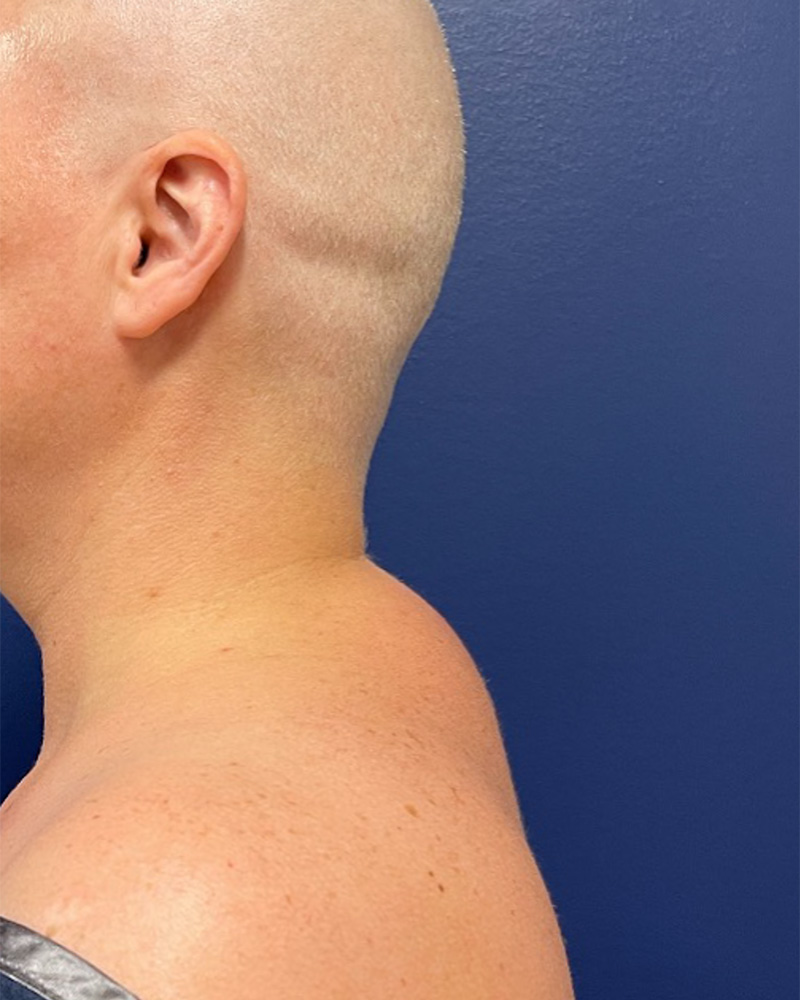 Case--9534 | Before Liposuction 1